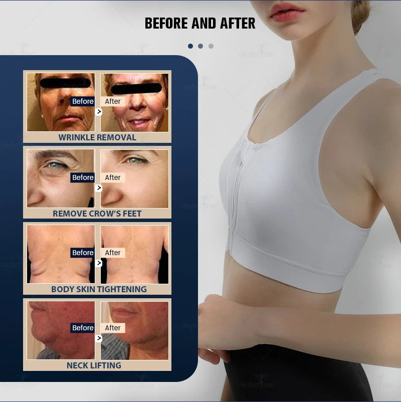 9D Professional Ultra-Sculpt: High-Intensity Focused Ultrasound (HIFU) System