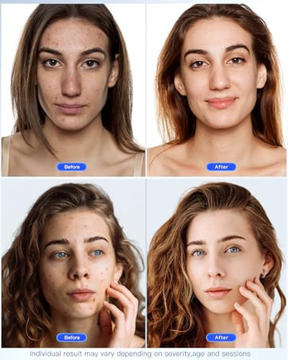 NEW!! LATEST!!! 7-Mode LED Face Mask – 150 LEDs for Wrinkles, Acne & Rejuvenation 🌟